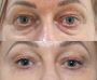 Upper Blepharoplasty Toronto for Eyelids Rejuvenation