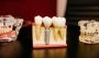 Refining Smiles with a Tailored Dental Implants Cost in Sydn