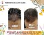 Best Carboxy Therapy for Hair Growth
