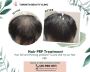 Best Hair Treatment For Receding Hairline