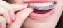 Avail The Best Invisalign at Narre Warren Avail The Best Invisalign at Narre Warren