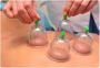 Use Sports Massage Cupping to Feel Better!
