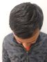 Get the Best Hair Transplant in Roorkee Today