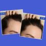 Fight Hair Loss Naturally with TYC Beauty's DHT Blocking Sha