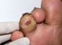 Urgent care for Diabetic Ulcers on Feet 