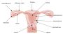 uterine fibroid removal 