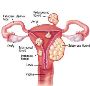 Pictures Of Fibroids