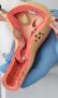 What is Considered a large Fibroid?