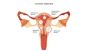 What Is Intramural Fibroid? Understanding Symptoms, Causes