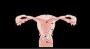 Is an Enlarged Uterus Disrupting Your Life? Get Help Now!