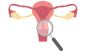 How to Treat Intramural Fibroids: Causes, Symptoms & Solutio