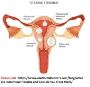 Intramural Leiomyoma of Uterus: Causes, Symptoms & Treatment