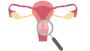 Intramural Leiomyoma of Uterus – Causes, Symptoms
