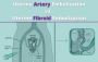 Fibroid Treatment Options: UAE vs UFE