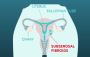 Subserosal Fibroids Can’t Stop You—Here’s Why