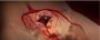 Understanding Subserosal Fibroids: Causes, Symptoms