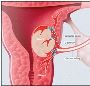Fibroid Ablation Treatment | Non-Surgical Relief at USA