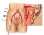 Fibroid Ablation Treatment | Advanced Non-Surgical Fibroid