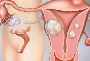 Can Fibroids Be Cancerous? What Every Woman Should Know