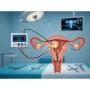 Fibroid Ablation: Minimally Invasive Relief