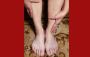 Telemedicine for Peripheral Artery Disease Treatment