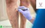 Varicose Veins Surgeon in Hyderabad | Vascularhyd