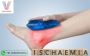 Acute Limb Ischemia Treatment in Hyderabad | Vascularhyd