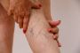 Trusted Varicose Veins Treatment in Hyderabad