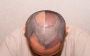 Hair Transplantation Treatment in Chennai