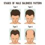 Hair Loss Treatment in Chennai