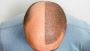 Hair Transplant in Chennai