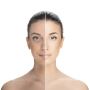 Skin Pigmentation Treatment in Chennai