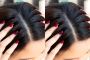 Hair Dandruff Treatment in Chennai