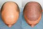 Hair Replacement in Chennai