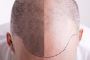 Best Hair Transplant