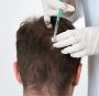Exosome Hair Treatmant