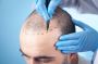 Best Hair Transplant Treatment 
