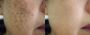 Skin Pigmentation Treatment