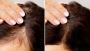 Hair Loss Treatment Near Me