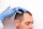Exosome Therapy for Hair
