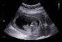 Sonography Tests for Pregnant Women in Dhanori