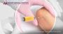 Non-Surgical Orthobiologic Therapy in NYC & NJ