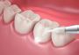 Best Gum Treatment in Villivakkam, Chennai