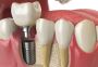 Best Tooth Replacement Hospital in Anna Nagar, Chennai