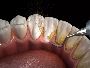 Teeth Cleaning Services in Ayanavaram Chennai