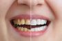 Perfect Smiles with Braces