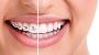 Orthodontic Care at Dental Oasis: Transform Your Smile