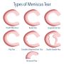 Speed Up Recovery with Proven Medial Meniscus Tear Treatment