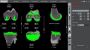 How Can Robotic Partial Knee Replacement Surgery Benefit You