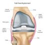 Opt for Reliable Total Knee Joint Replacement